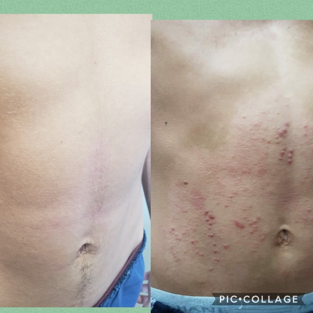 Dupixent antes e depois