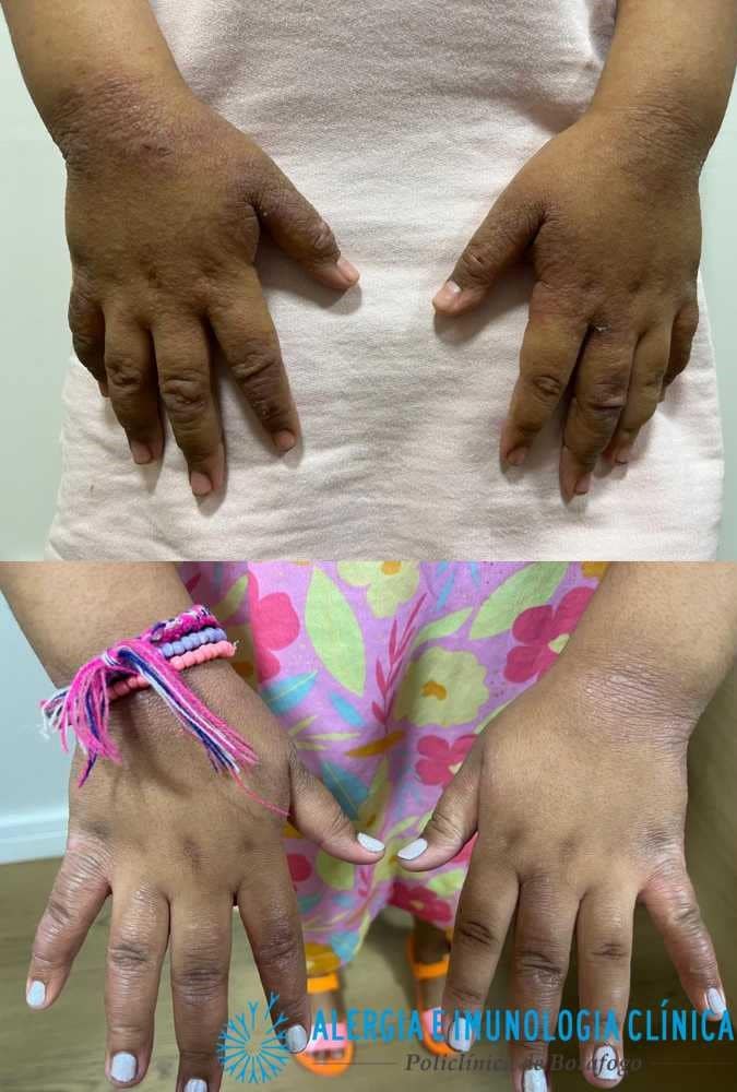 dupixent antes e depois em criança