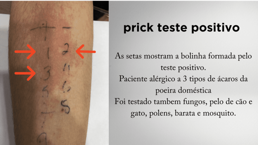 prick teste positivo